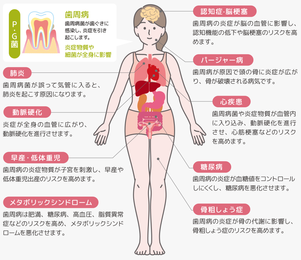 歯周病と全身疾患の関係